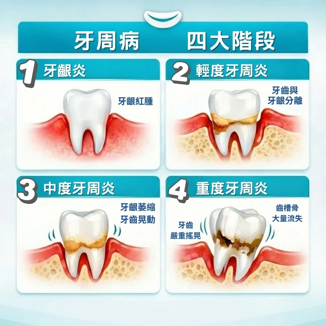 牙周治療 牙周治療